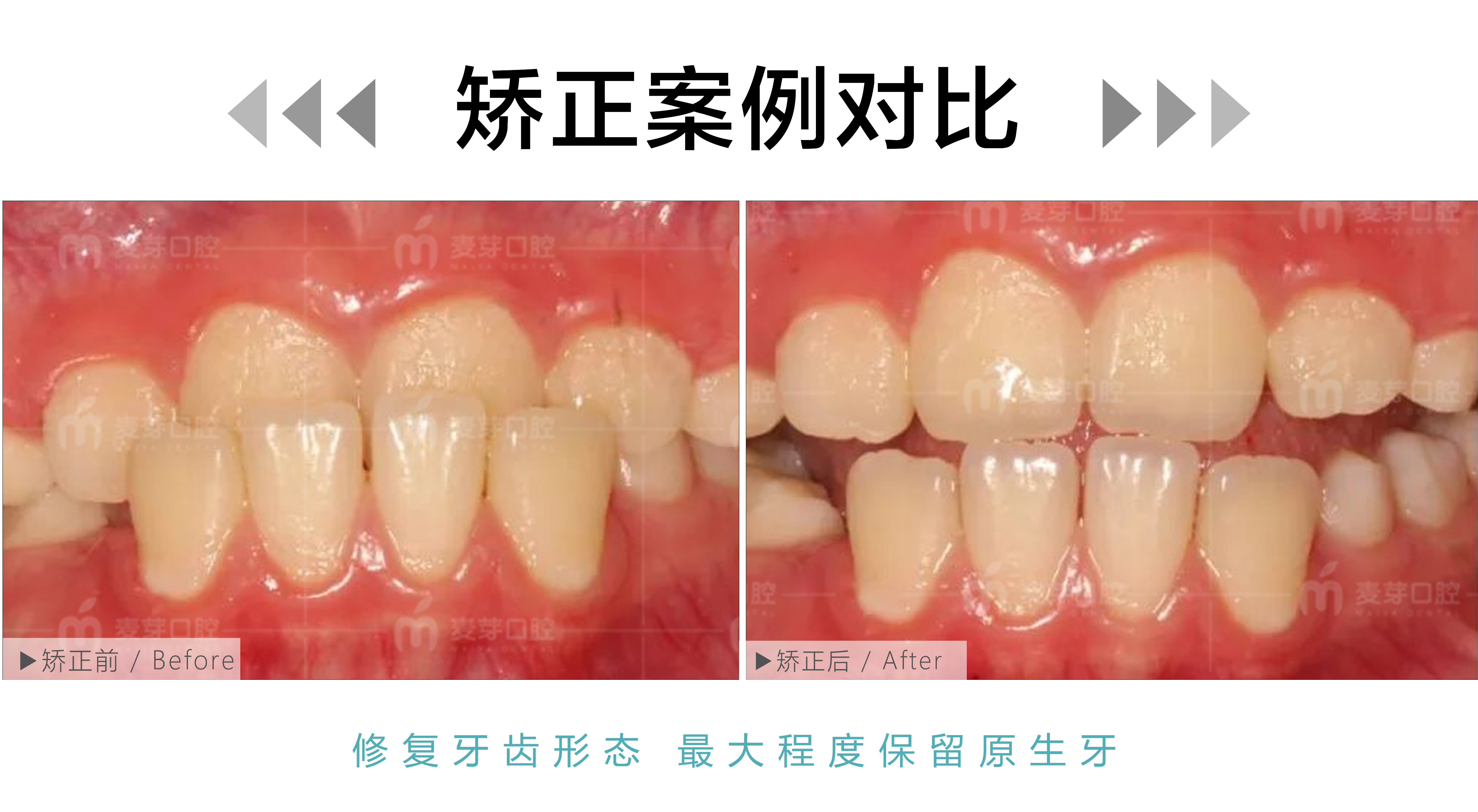 9岁儿童骨性地包天肌功能早期干预