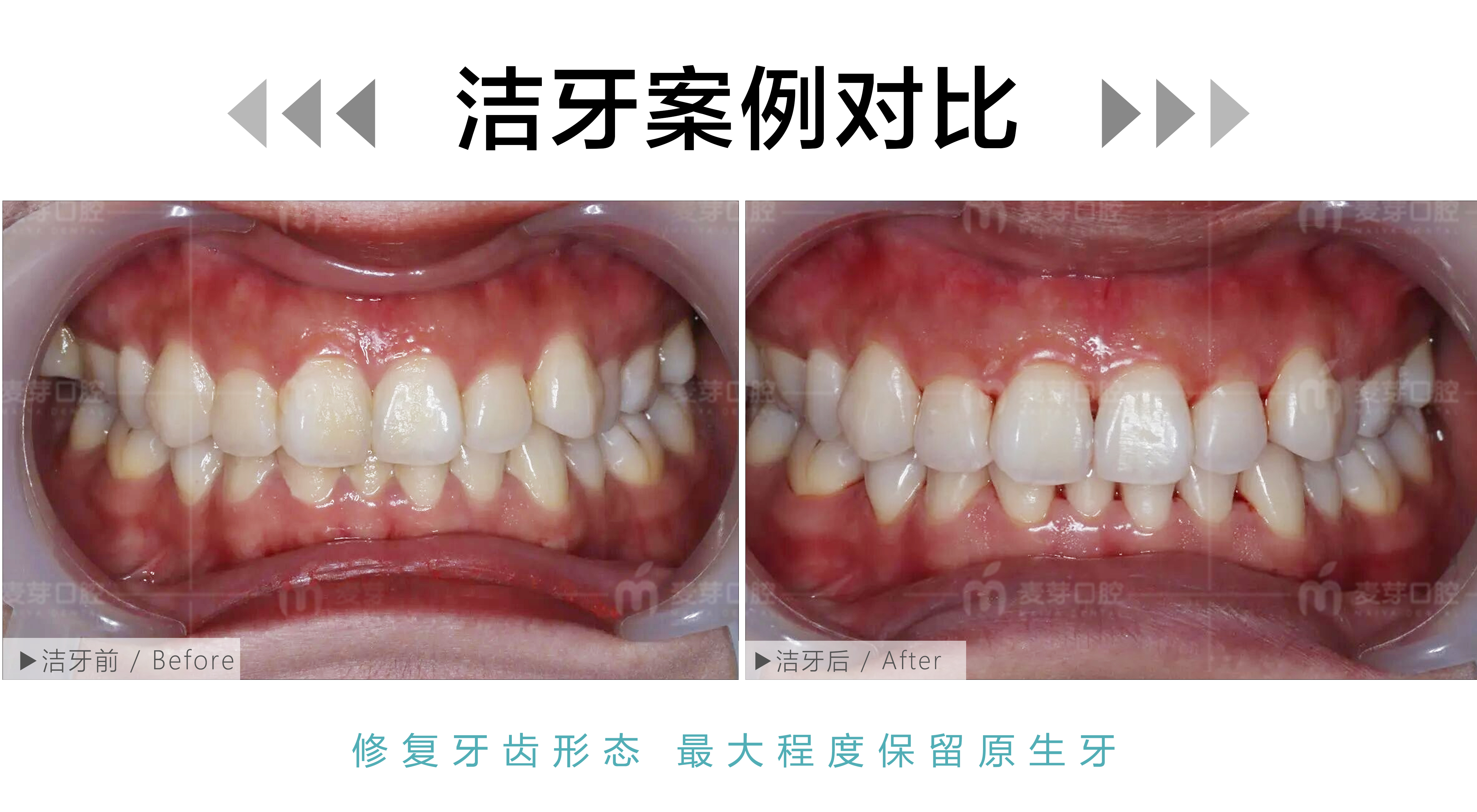 上班族工作日抛光洁牙