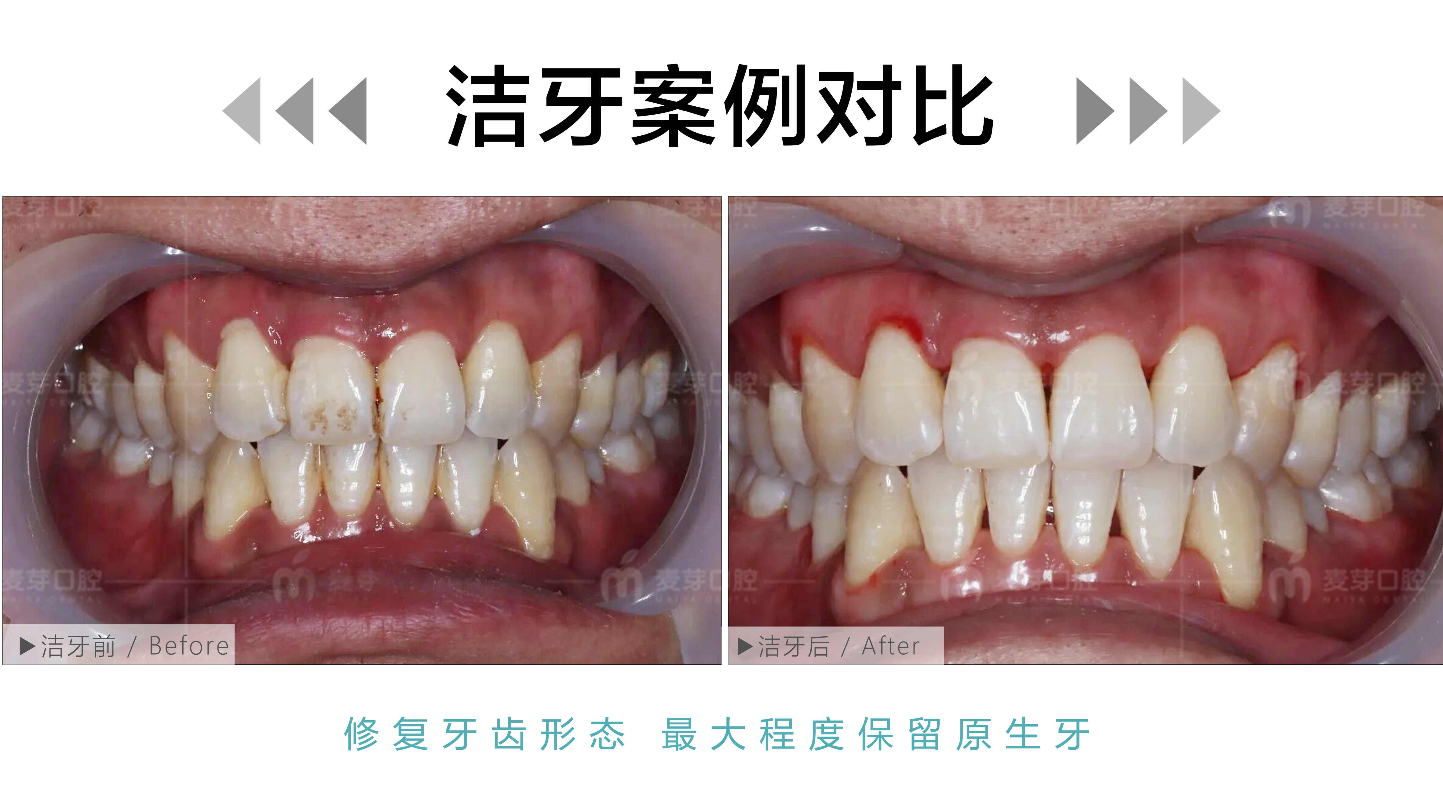 中年男士烟渍喷砂洁牙