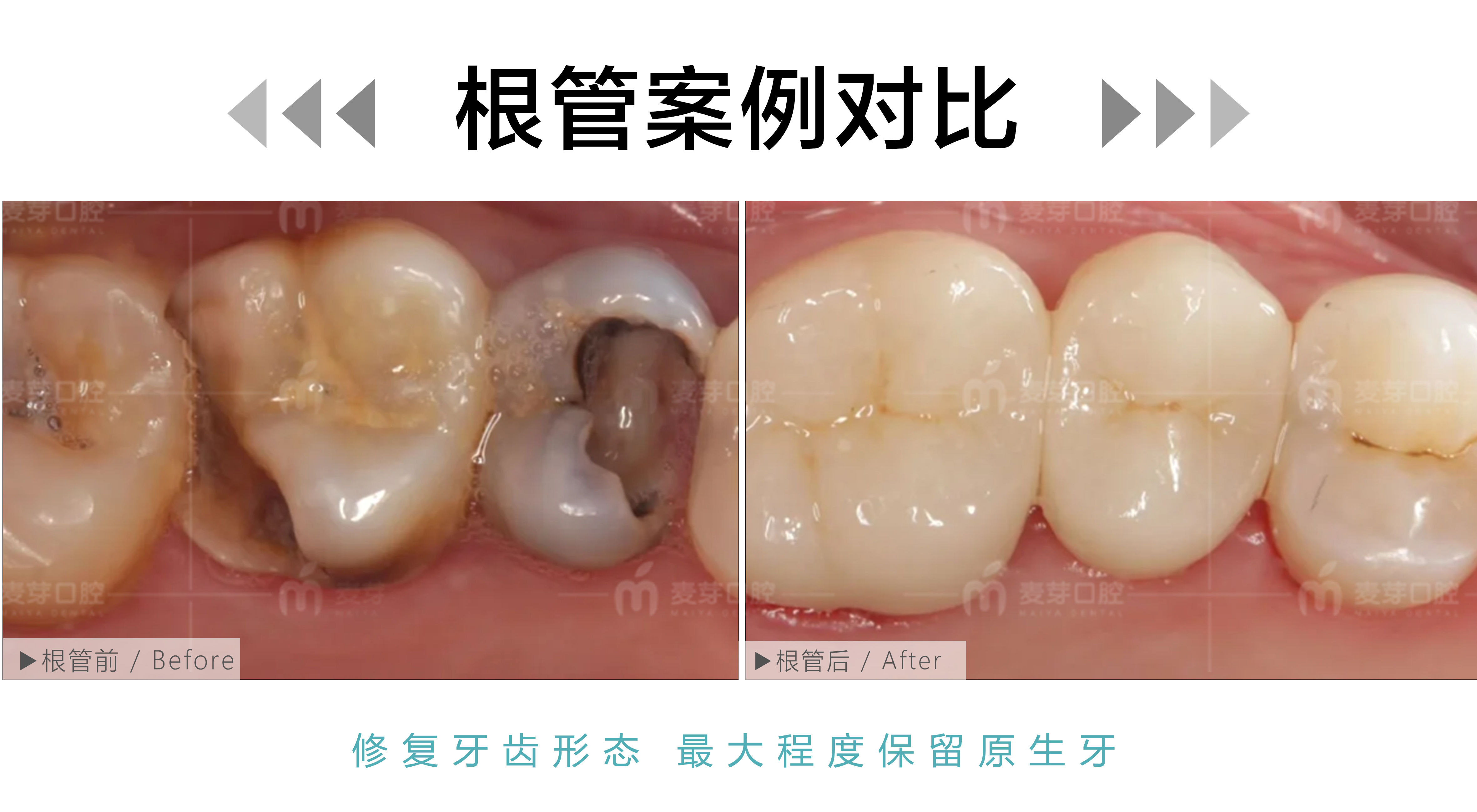 根管后全瓷冠联合修复