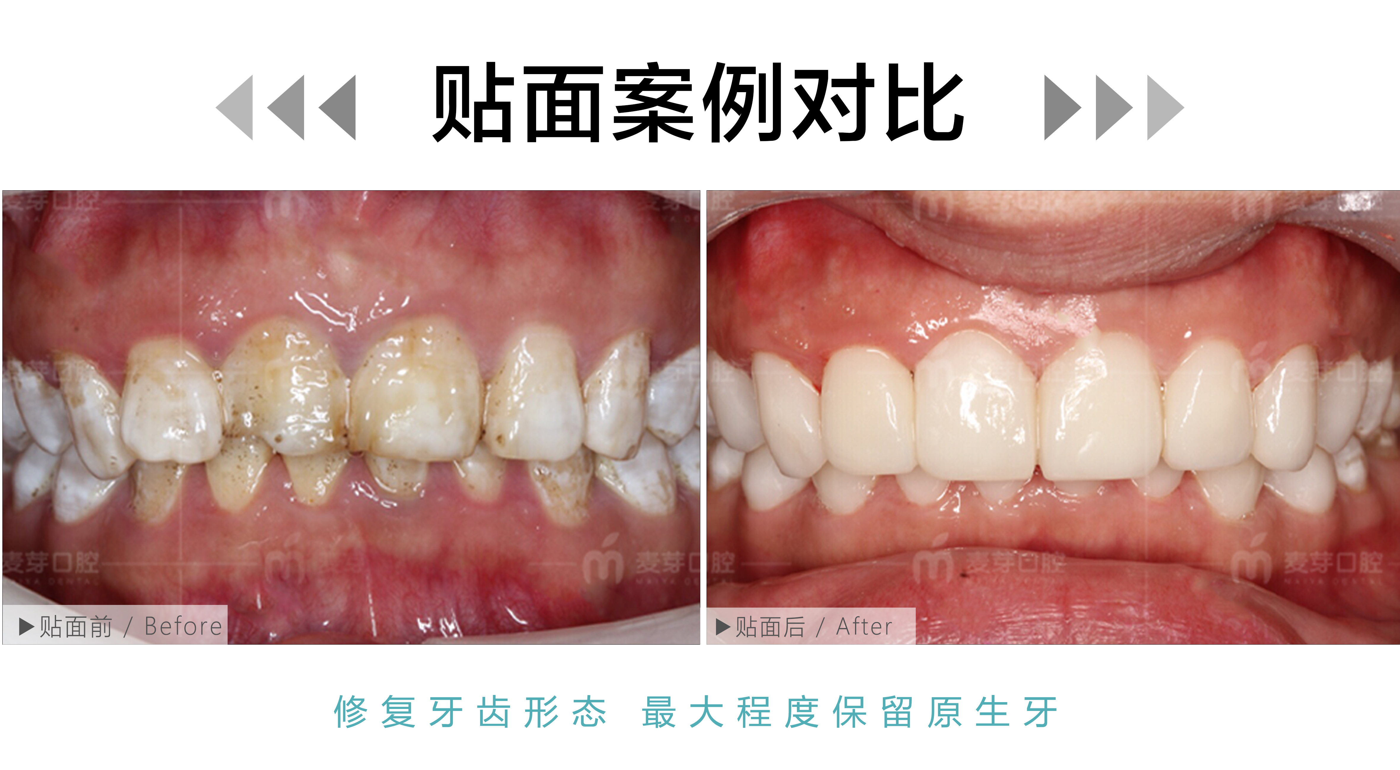 重度氟斑牙瑞士EMAX铸瓷贴面